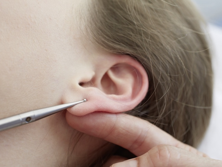 Akupunktur Massage nach Radloff